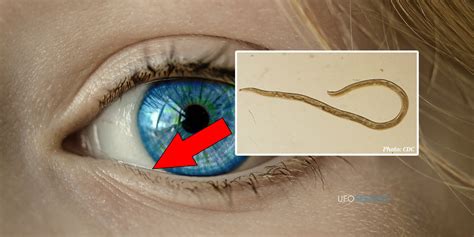  Eyelash Worm: It Has Eyelashes, But Doesn't Bat An Eye! Discover This Tiny Parasite With A Big Impact